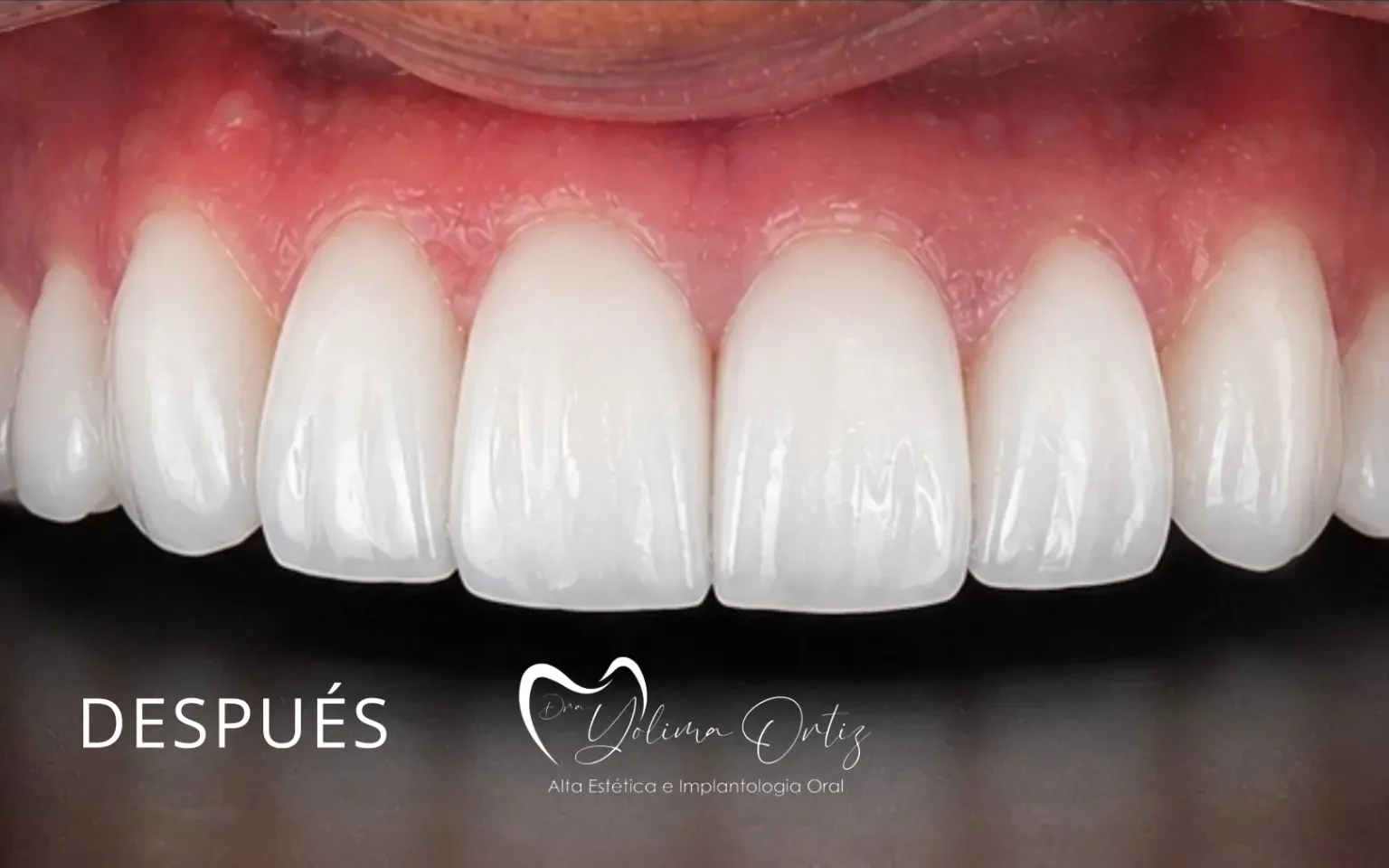 Diseño de sonrisa con carillas de porcelana — después