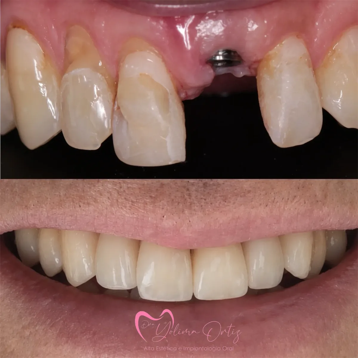 Caso real de implante dental — antes y después