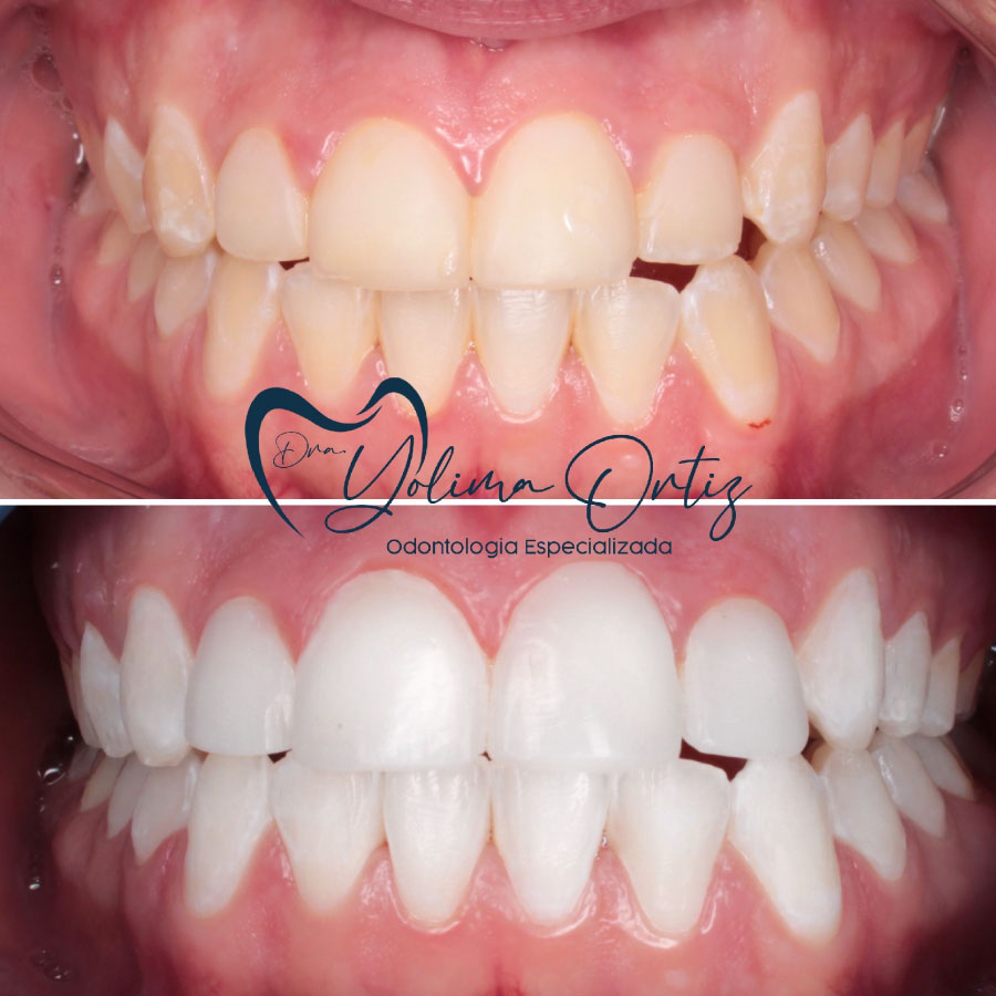 diseño de sonrisa y aclaramiento dental
